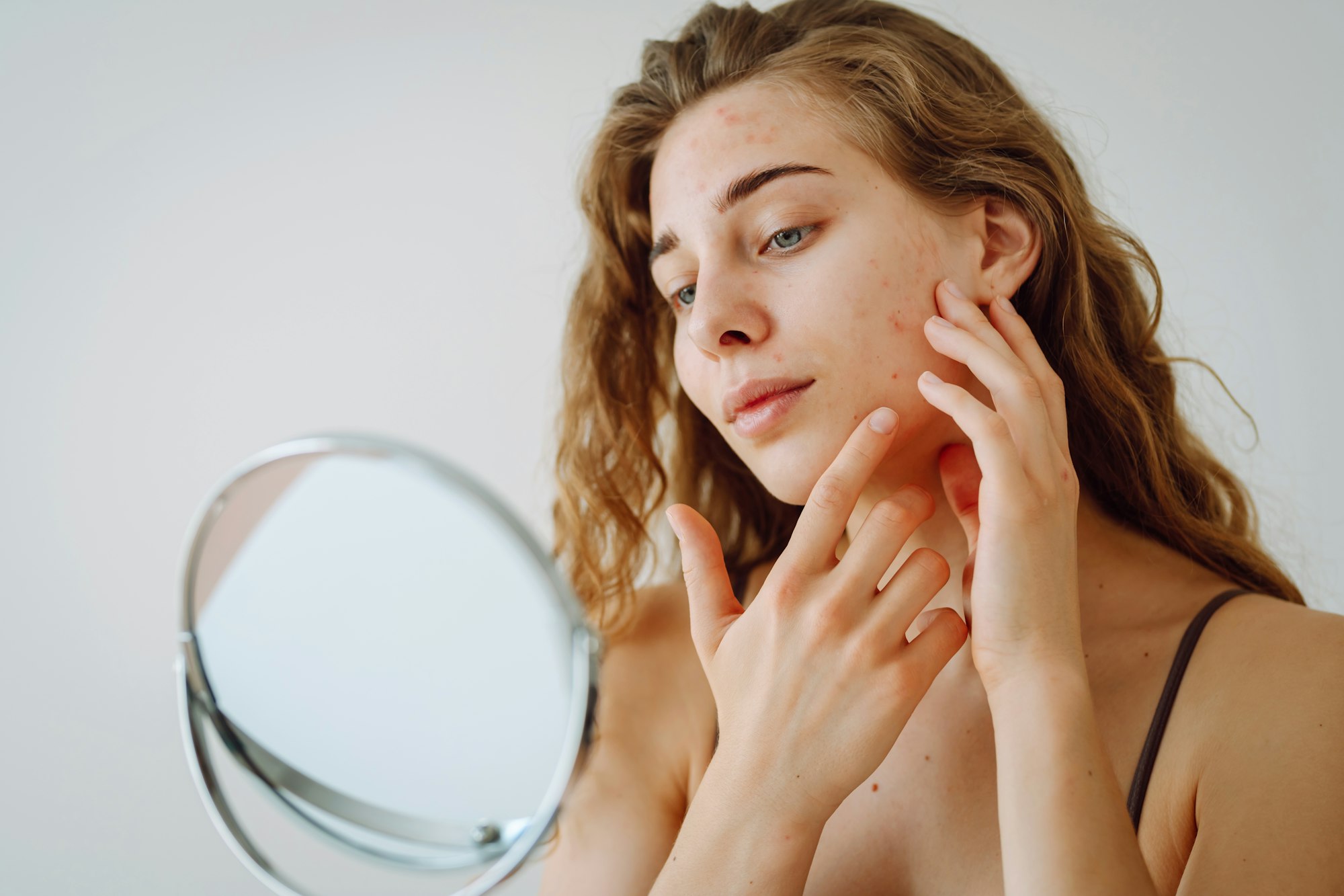 Close-up of a cute woman with problem skin looking in the mirror. Dermatology concept, allergy.